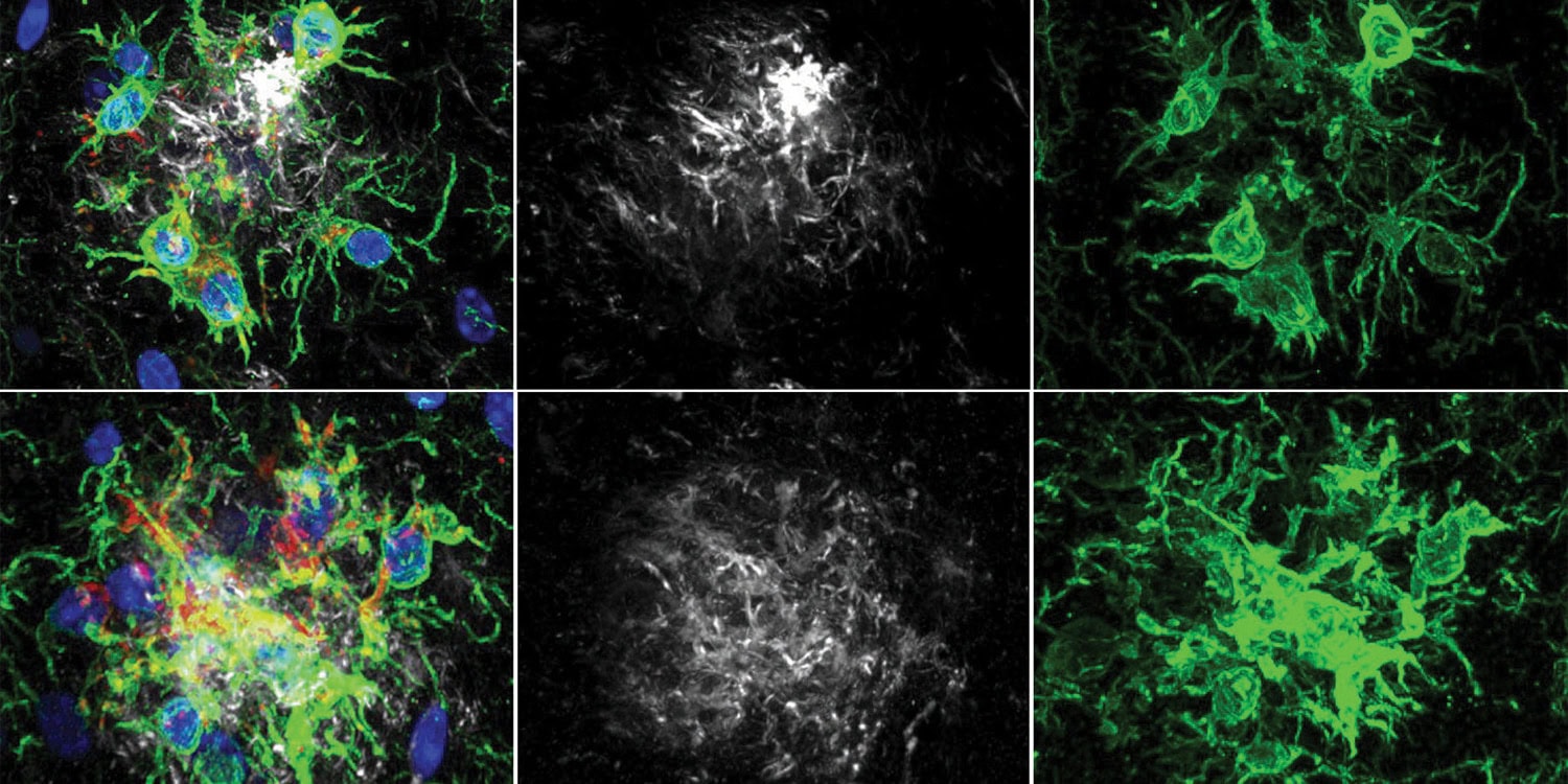 Enzym z cukrzycy może leczyć Alzheimera. Nowe odkrycie naukowców